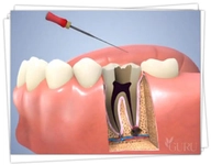 Diş Apsesi Tedavisi Nelerdir?