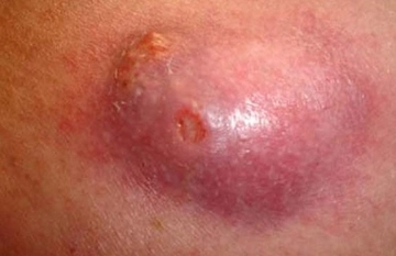 Anal Apse Belirtileri ve Tedavisi