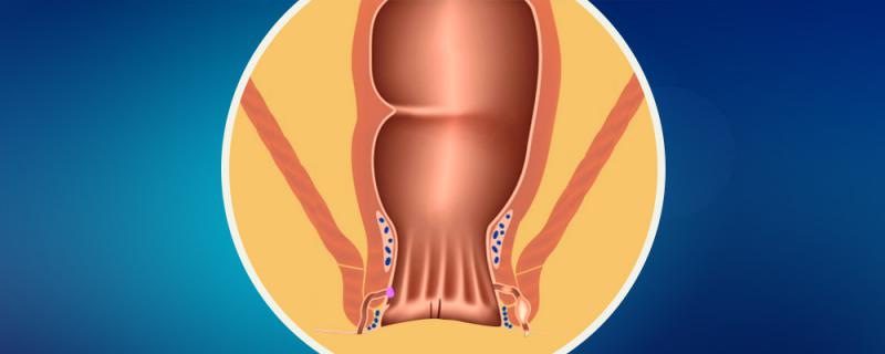 Anüste Apse Anüs Apsede Tanı Nasıl Konulur?