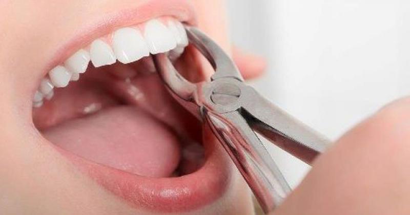 Diş Apsesi Nasıl İner